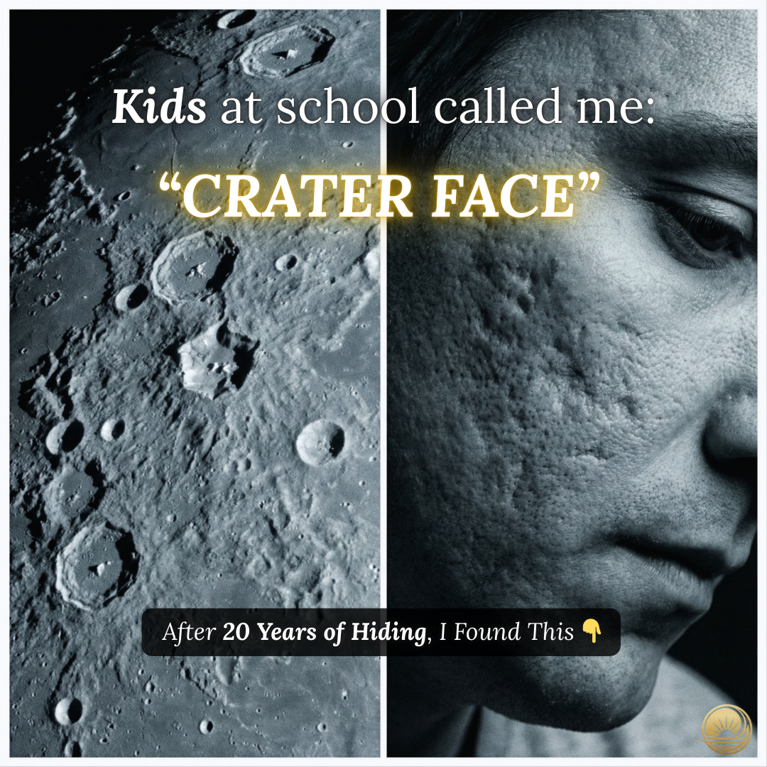 Autumn Rose Facebook ad: My Face Looked Like the Moon Because of the 'Holes' (The…