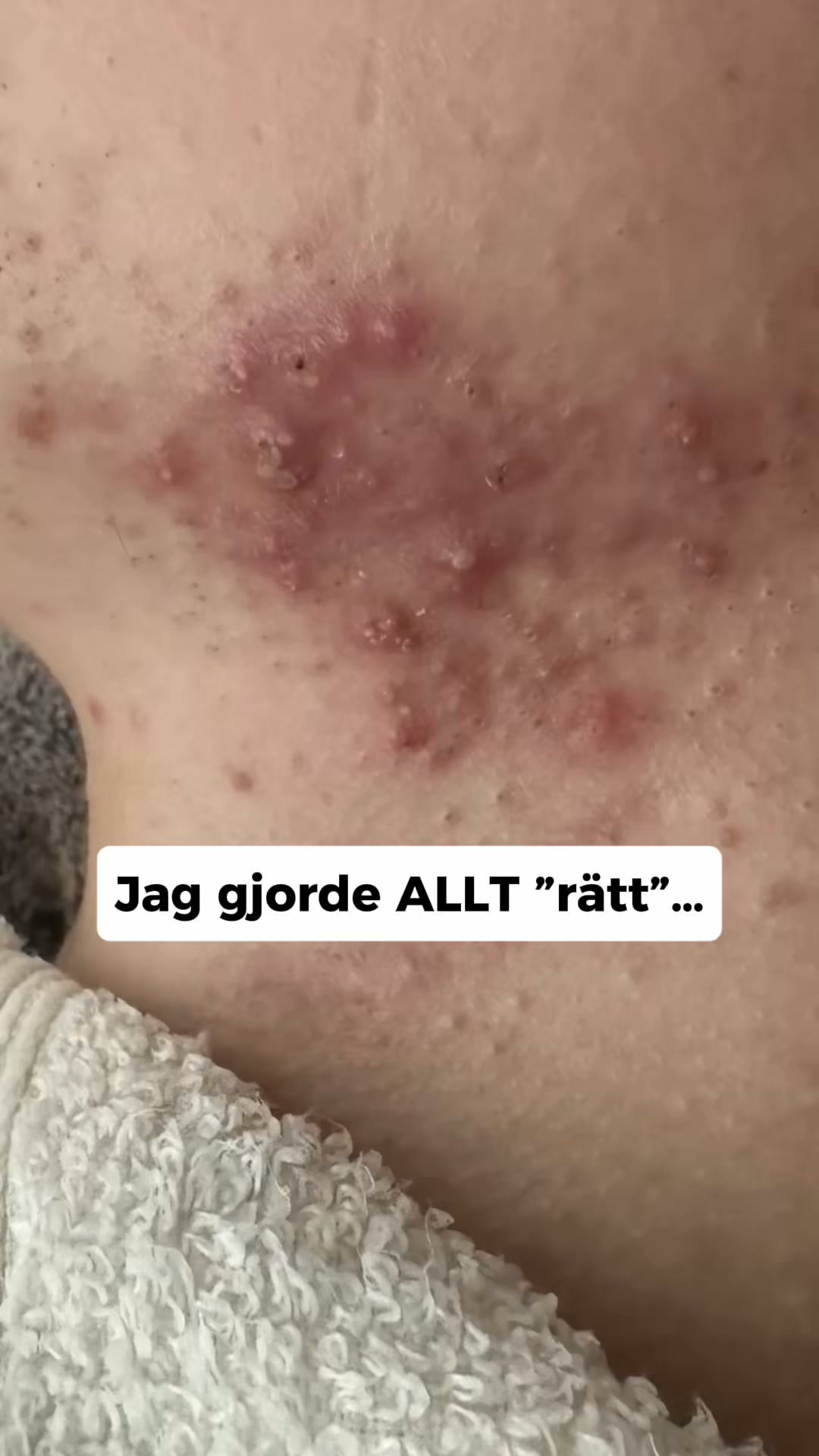 LovieBaby Facebook ad: Naturlig hudvård för akne