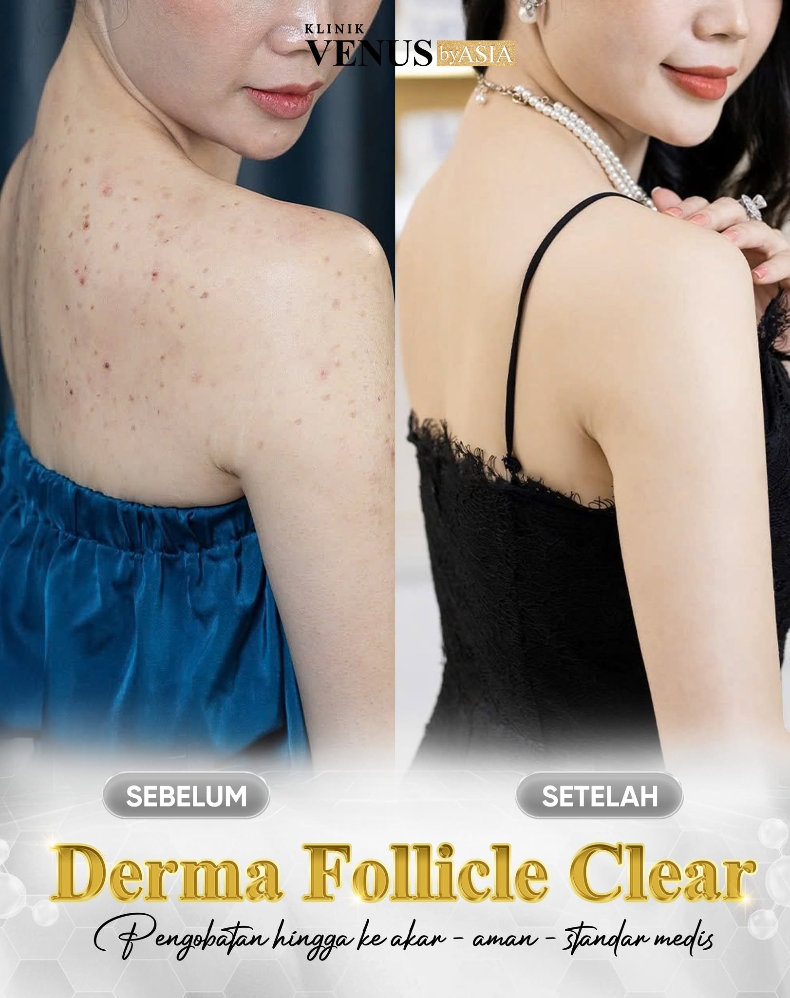 Derma Follicle By Venus Aisa Facebook ad: BAGAIMANA PERUBAHAN PUNGGUNG SETELAH 2 BULAN MENJALANI…
