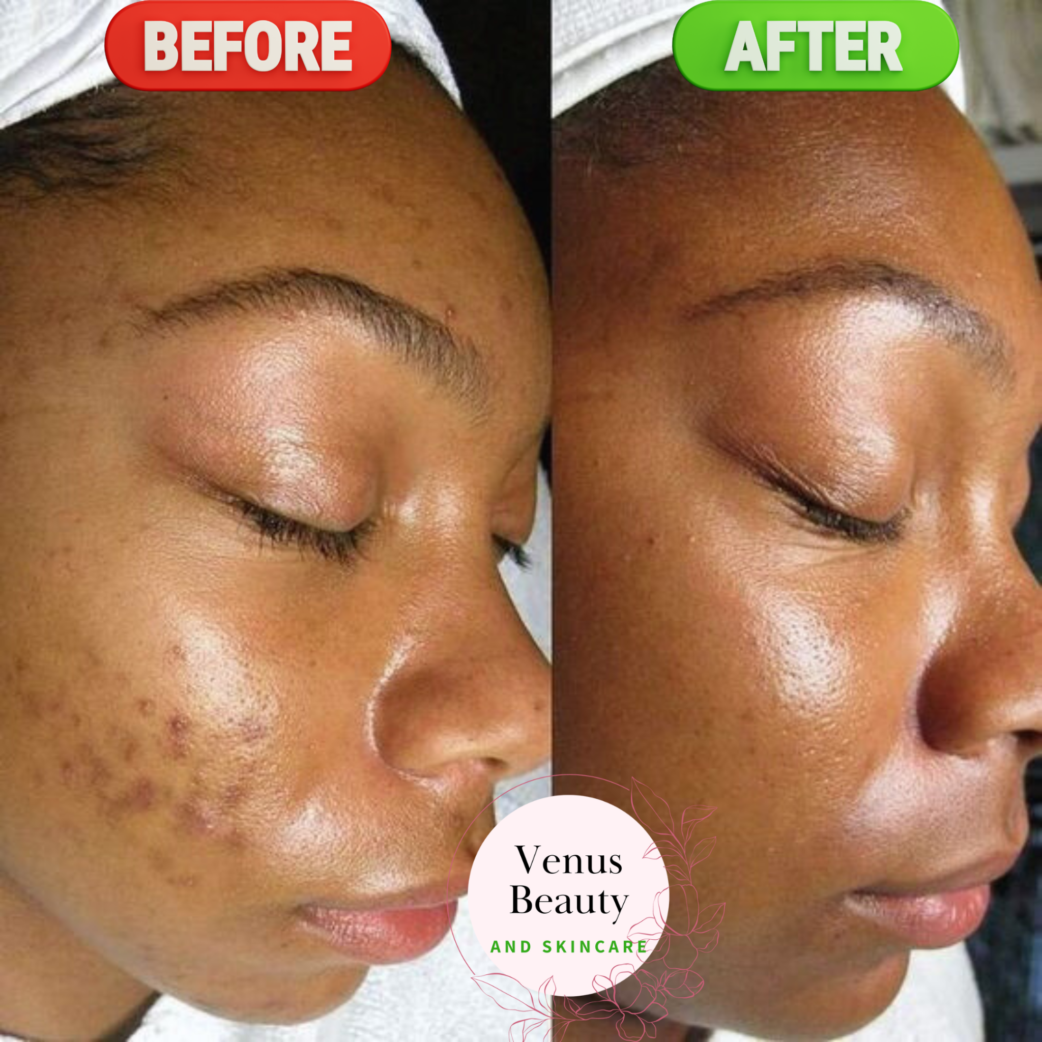 Venus Beauty and Skin Care Facebook ad: 𝐙𝐄𝐍𝐀 𝐀𝐋𝐆𝐀𝐄 𝐏𝐄𝐄𝐋 𝐓𝐑𝐄𝐀𝐓𝐌𝐄𝐍𝐓