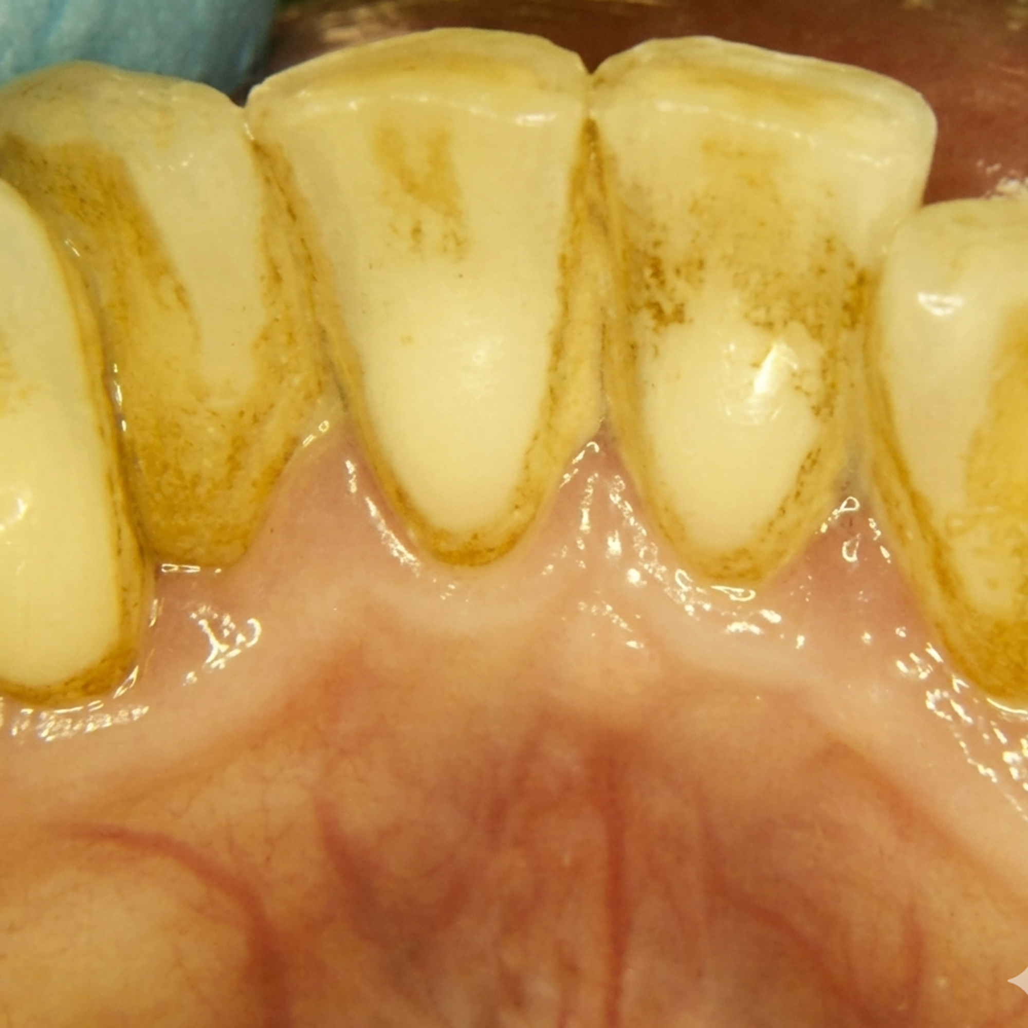 Smile Reset Facebook ad: Why Every Whitening Strip Is Making Your Smoker's Teeth…