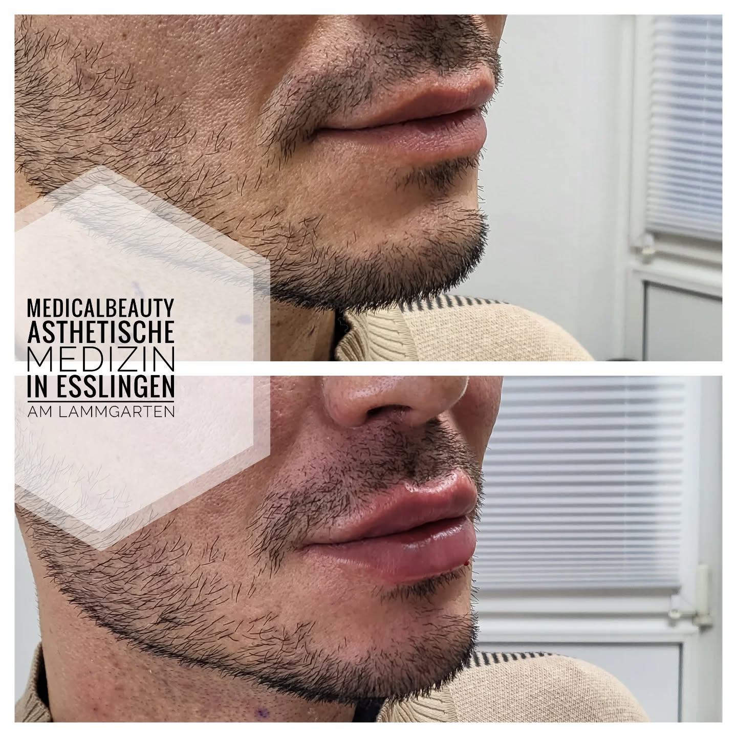 medicalbeauty_med.aesthetik Facebook ad: Christmas Lips Special in Esslingen