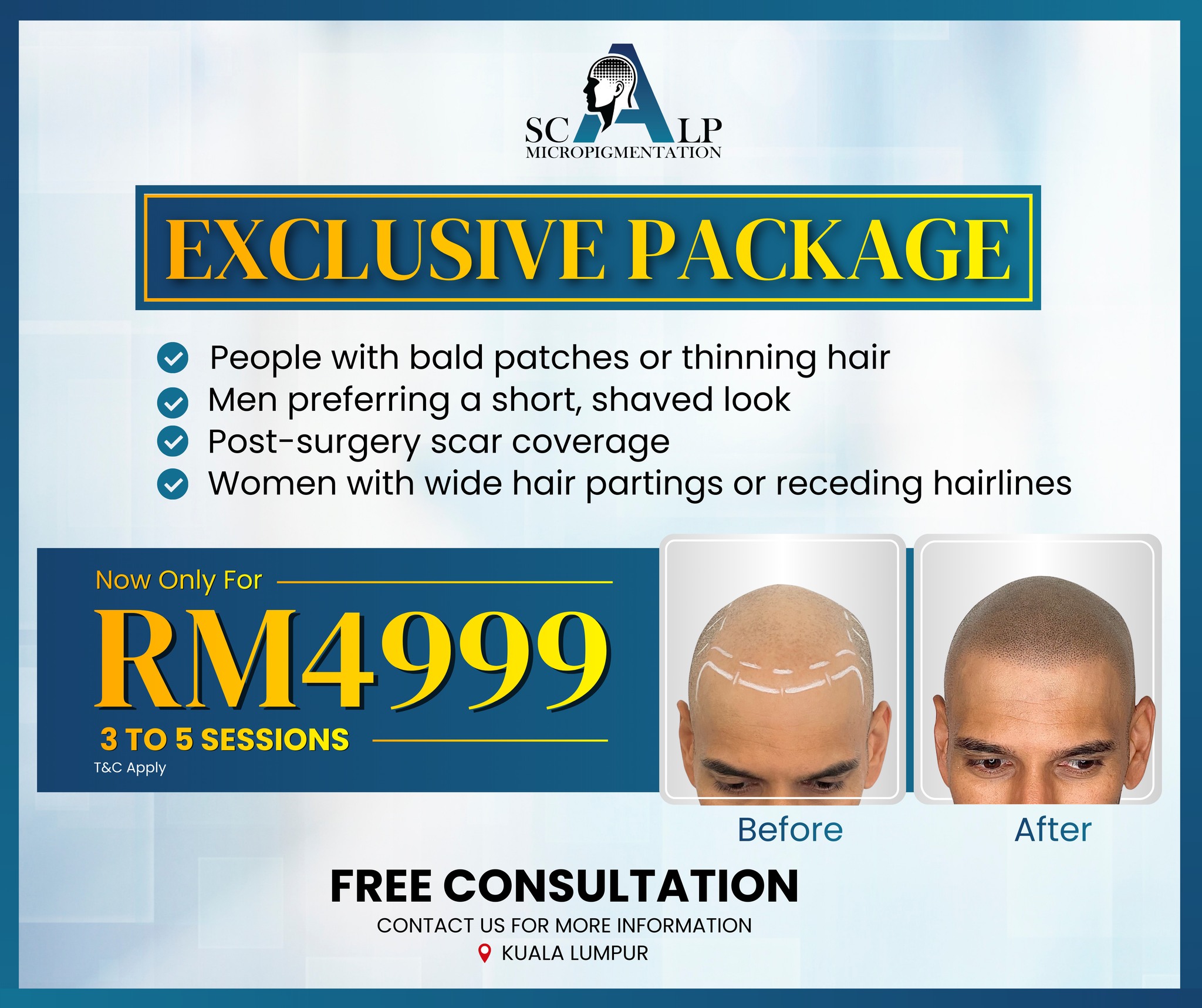 Advanced Scalp Micropigmentation Facebook ad: EXCLUSIVE SMP PACKAGE, LIMITED OFFER