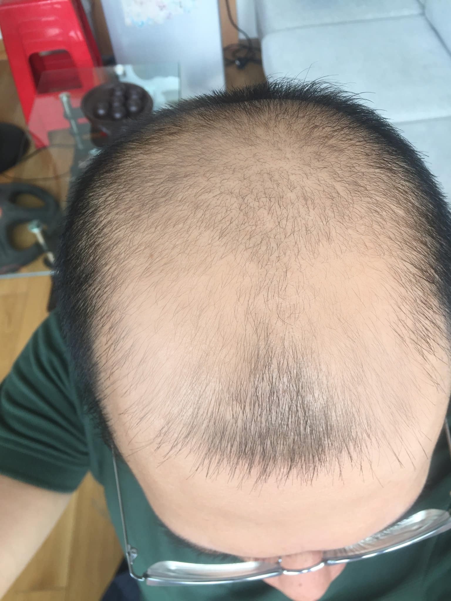 Rosa Beauty Clinic - Angeles City Facebook ad: [Treatment for Complete Hair Loss on the Scalp…