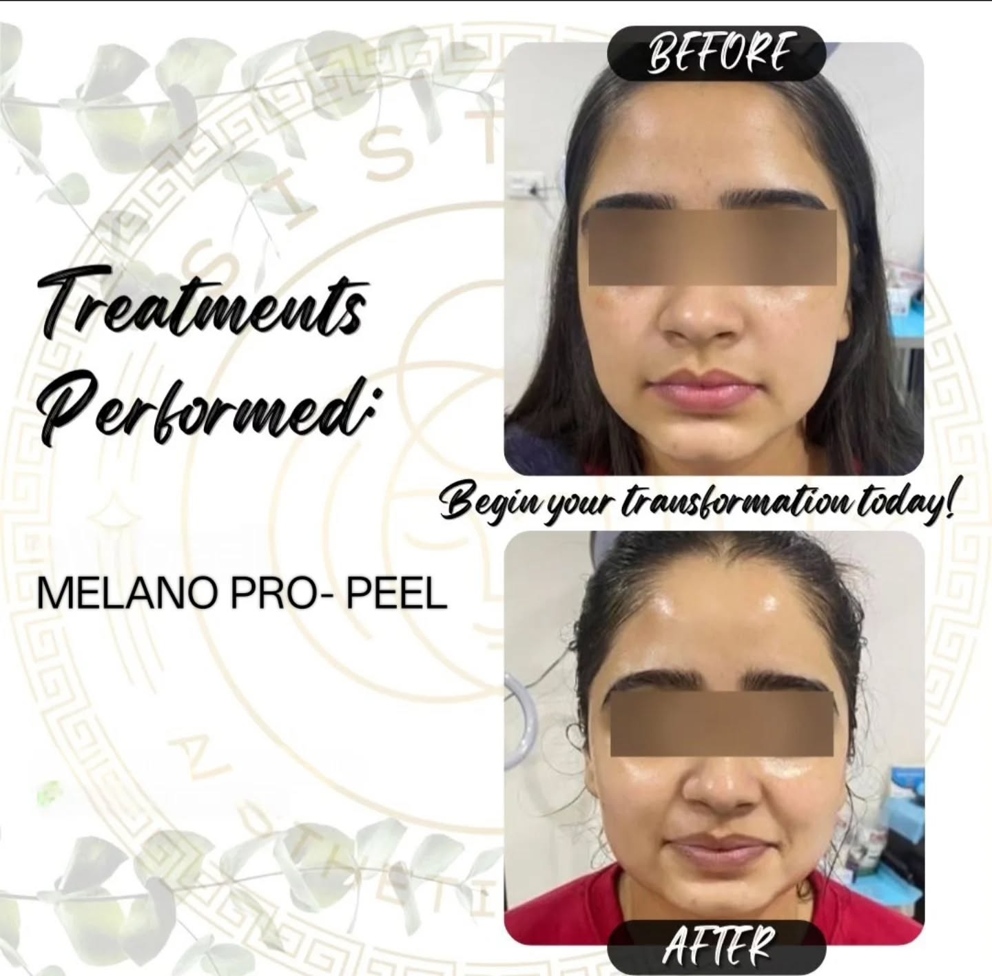meline_pakistan Facebook ad: Melano Pro- Peel Results.