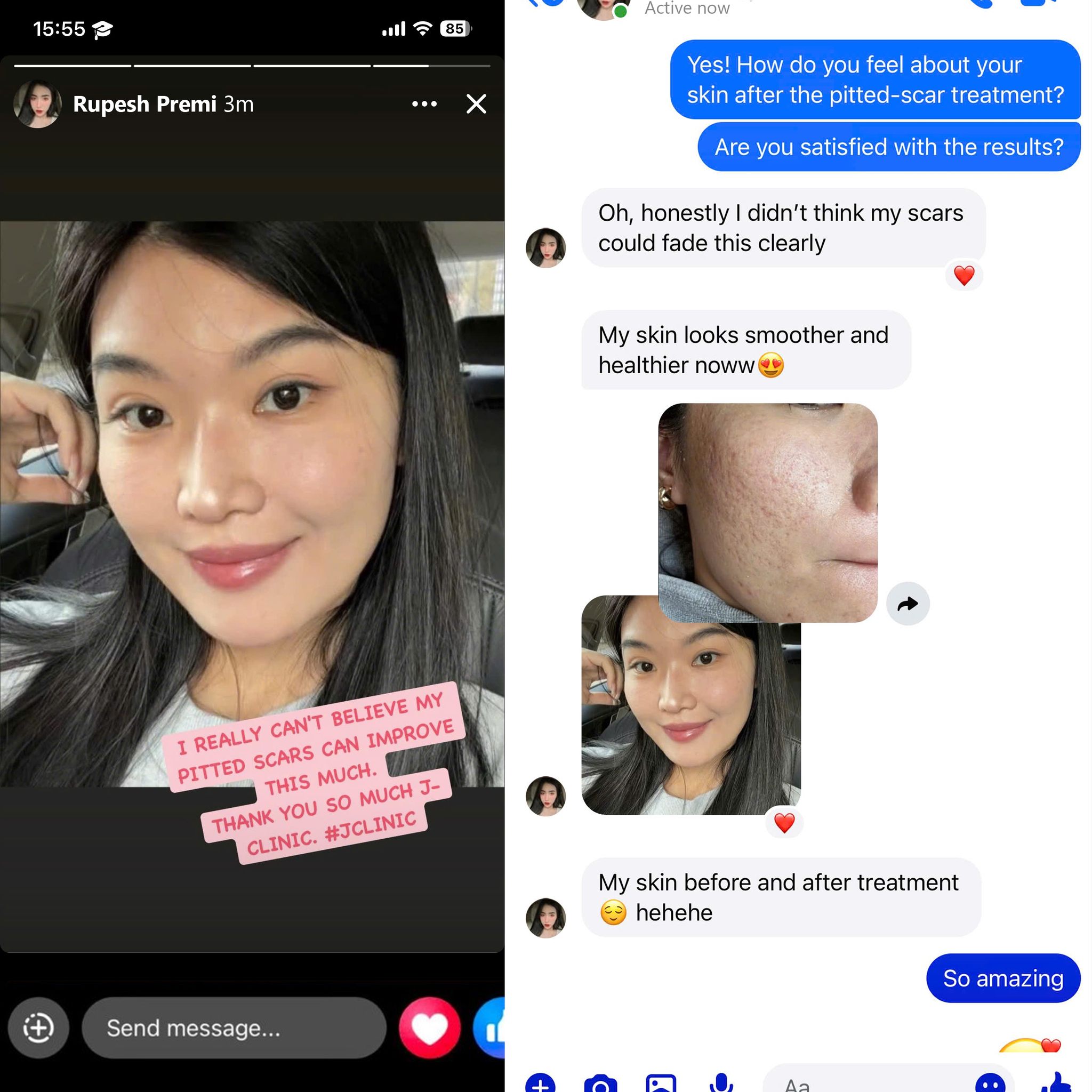 J Clinic - Skin Health & Restoration Facebook ad: PITTED SCAR TREATMENT, CLEARER, HEALTHIER SKIN