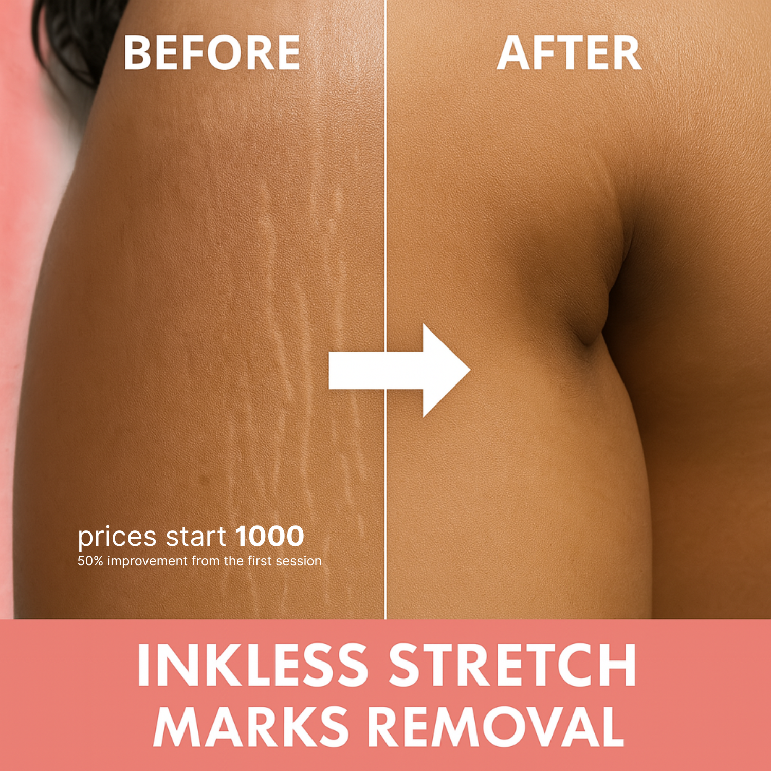 Skin Camouflage Facebook ad: Stretch Marks Removal Treatment