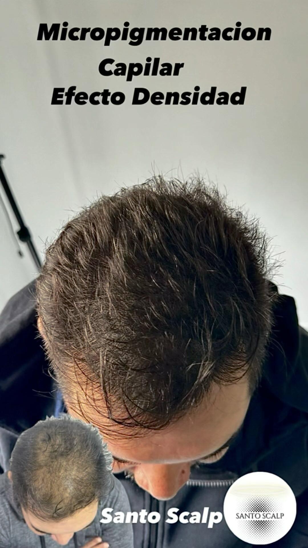 Santo Scalp Facebook ad: Micropigmentacion Capilar Efecto Densidad!