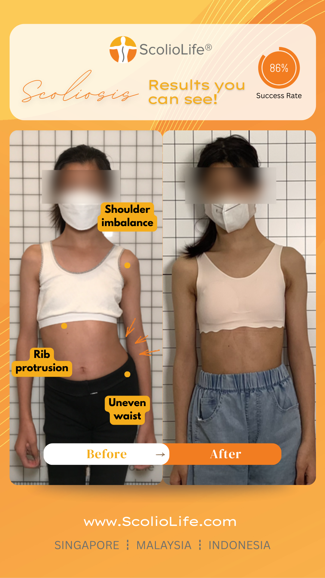 ScolioLife - Scoliosis & Spine Clinic KL Malaysia Facebook ad: At ScolioLife, we specialize in non-invasive scoliosis…