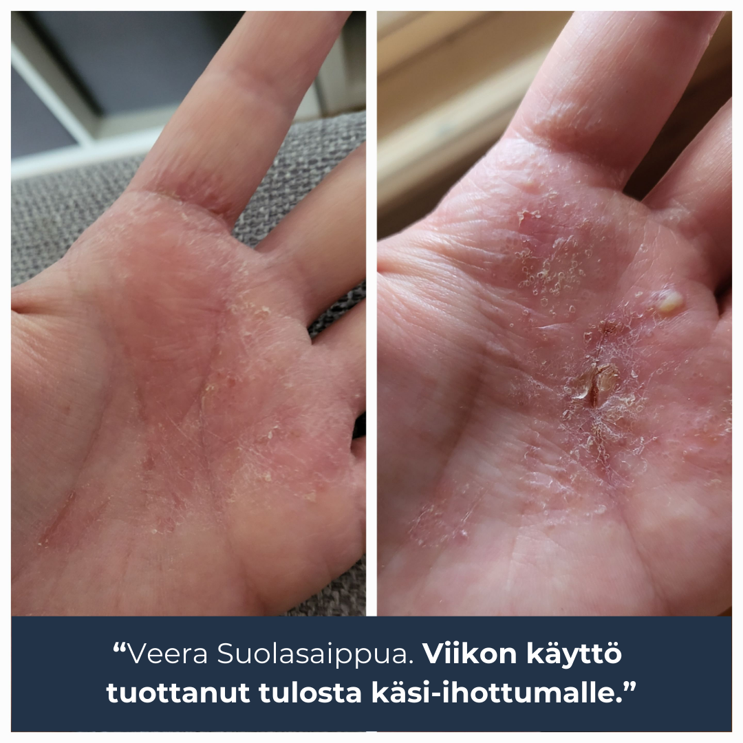 Saaren Taika Facebook ad: Sheivausnäppylät kadonneet melkein kokonaan jo parin…