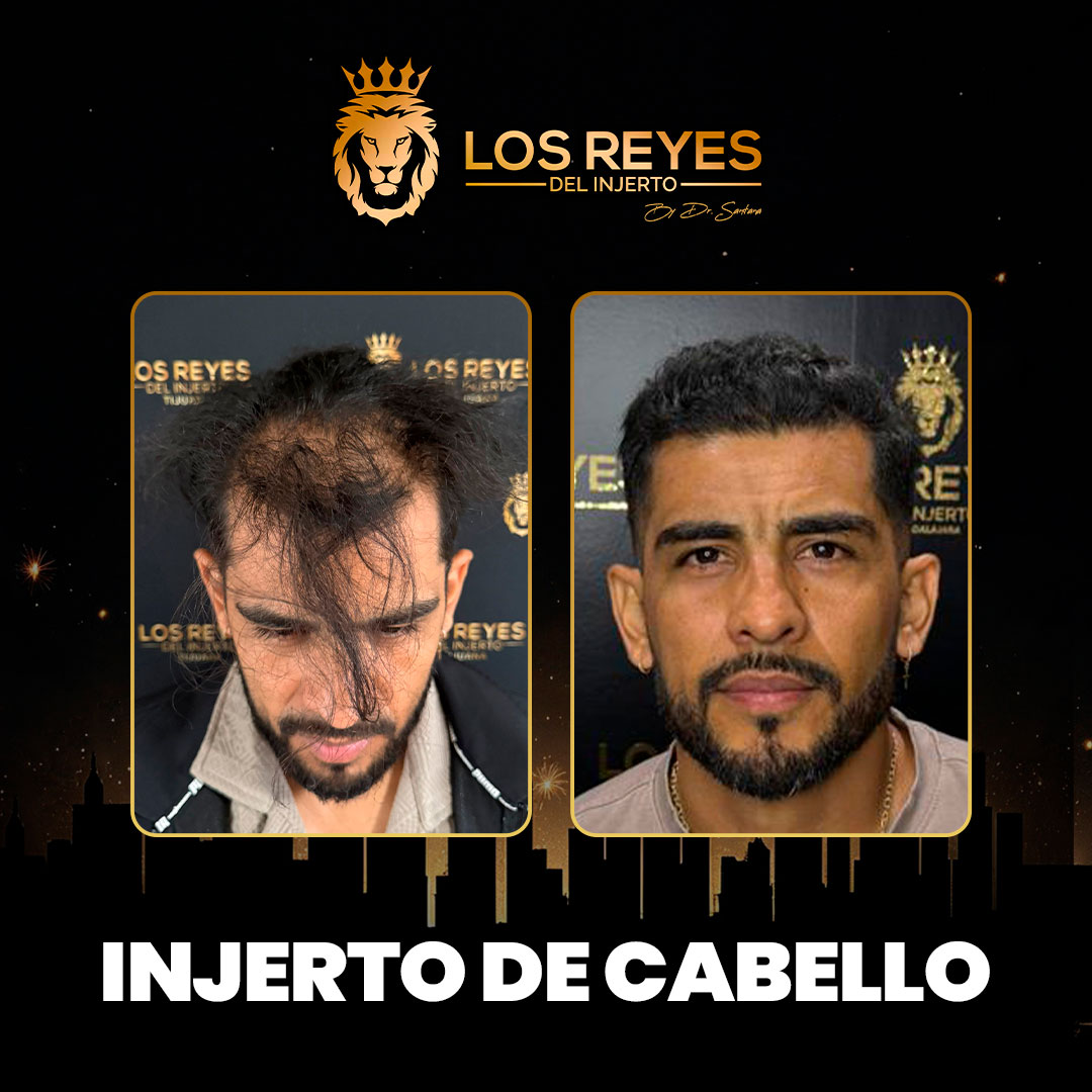 Los Reyes Del Injerto Facebook ad: Recupera tu cabello y vuelve a verte seguro