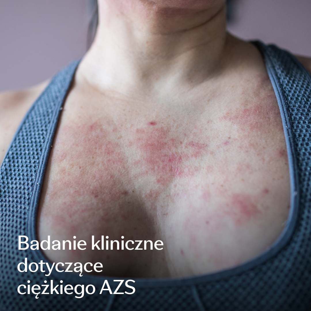 Eczema Research Study Facebook ad: Rozwój badań naukowych