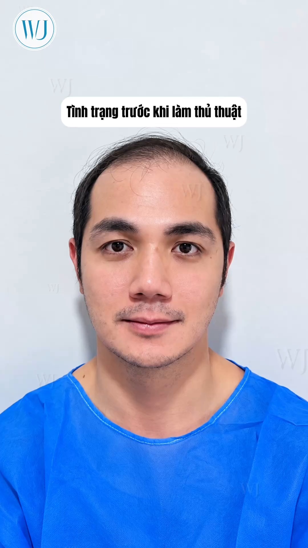 Viện Cấy Tóc Tự Thân WangJing DNA BioHair Facebook ad: LẤY LẠI 10 NĂM THANH XUÂN CHỈ SAU…