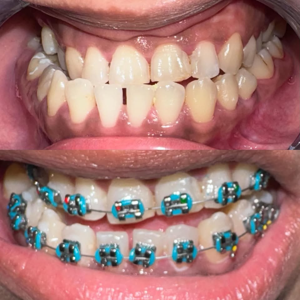 C.Bernardo Dental Clinic Facebook ad: ORTHO INSTALLED!