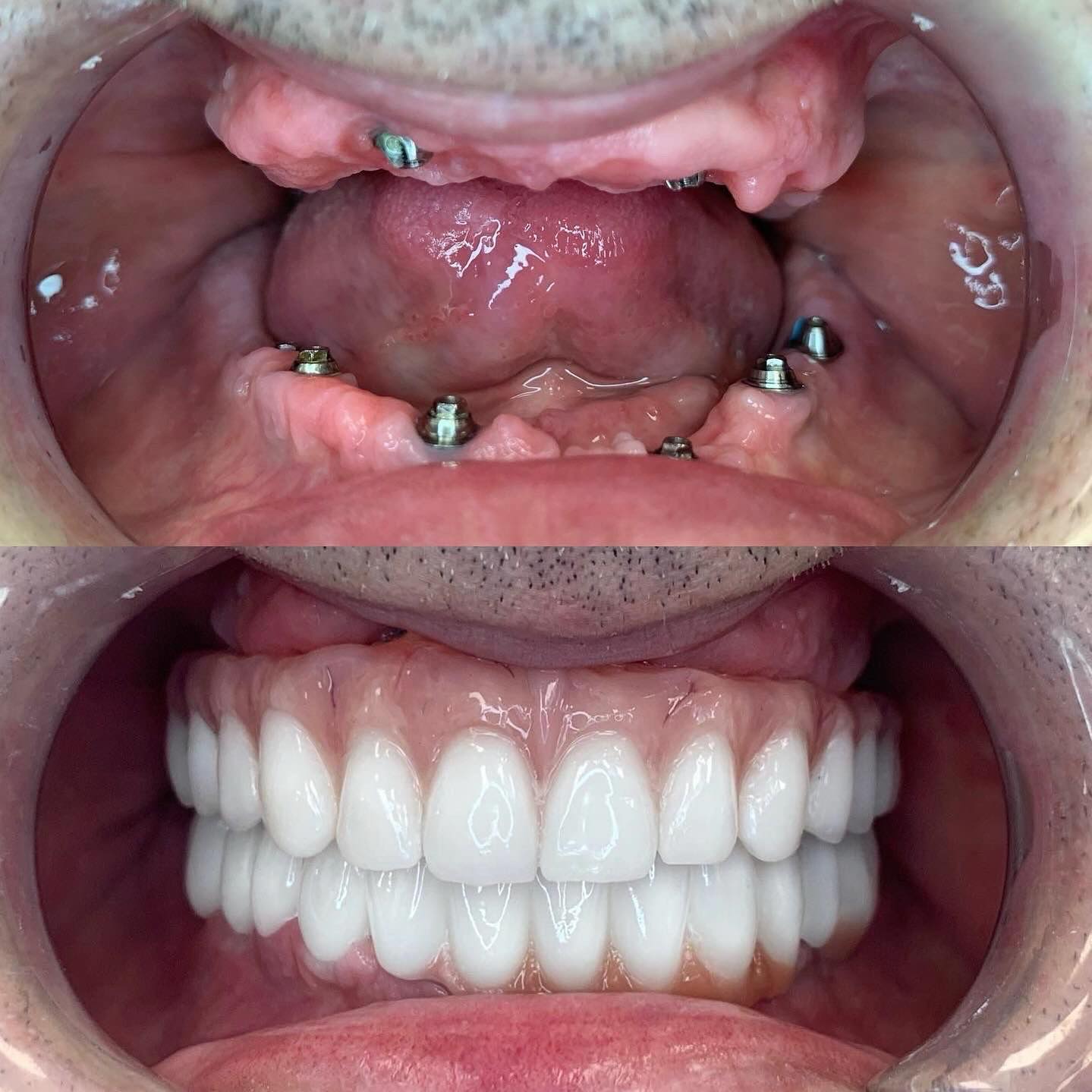 crowndental.rs Facebook ad: Postignite savršen osmeh sa All-on-4 za gornju vilicu…