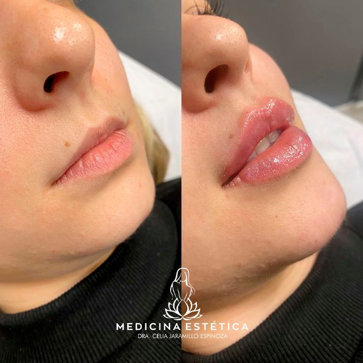 Dra. Celia Jaramillo Espinoza Medicina Estética Facebook ad: 𝘼𝙐𝙈𝙀𝙉𝙏𝙊 𝘿𝙀 𝙇𝘼𝘽𝙄𝙊𝙎