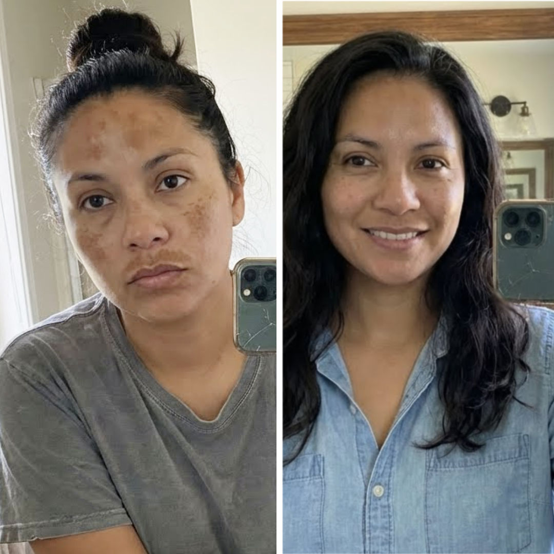 OMIC+ Skincare Facebook ad: If you suffer from melasma read this
