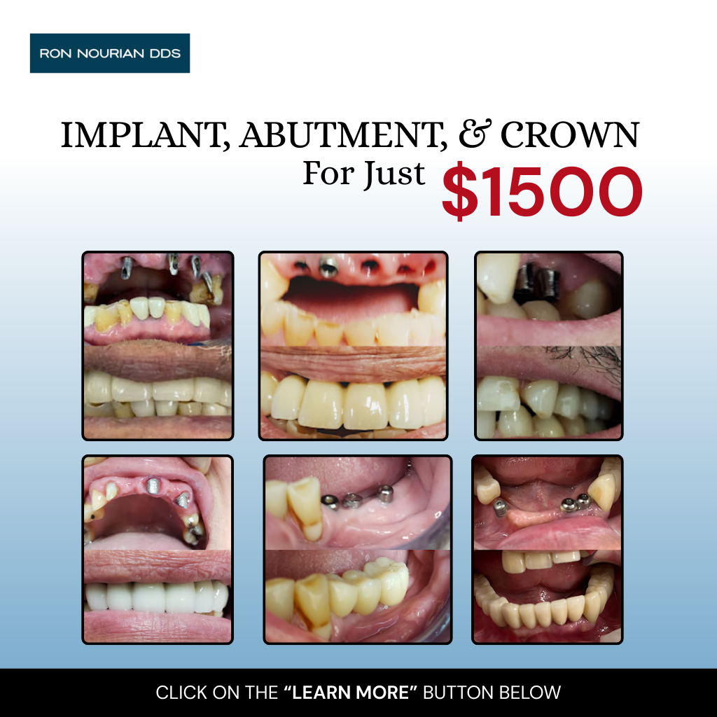 Dr. Ron Nourian DDS Facebook ad: Hello Los Angeles! New Year Special IMPLANT ABUTMENT AND…