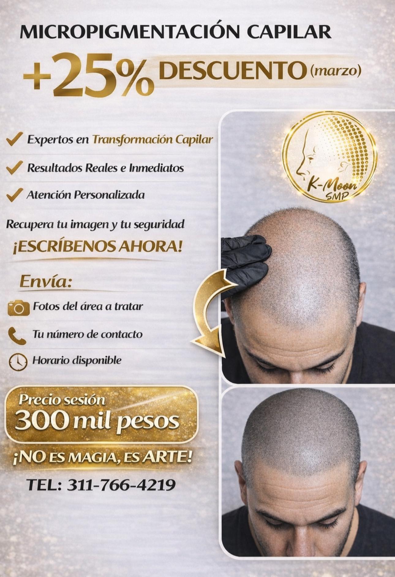 KMOON SMP Facebook ad: SOLUCIÓN # 1 - CONTRA LA CALVICIE