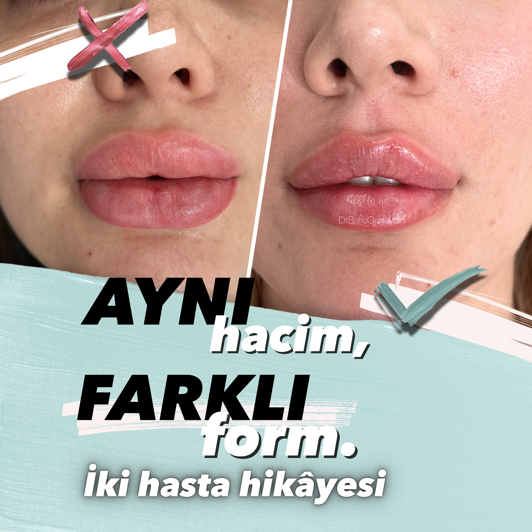 Uzm. Dr. Barış Günaydın Facebook ad: Doğal hacim için acele yok.