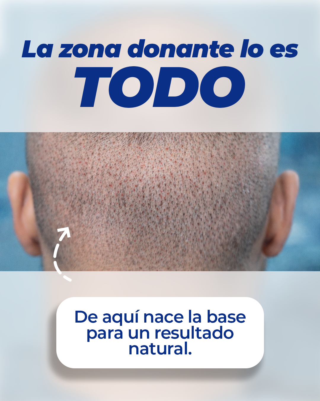 Robotica Capilar · Trasplante Capilar · Hair Restoration · Rejuvenecimiento Facebook ad