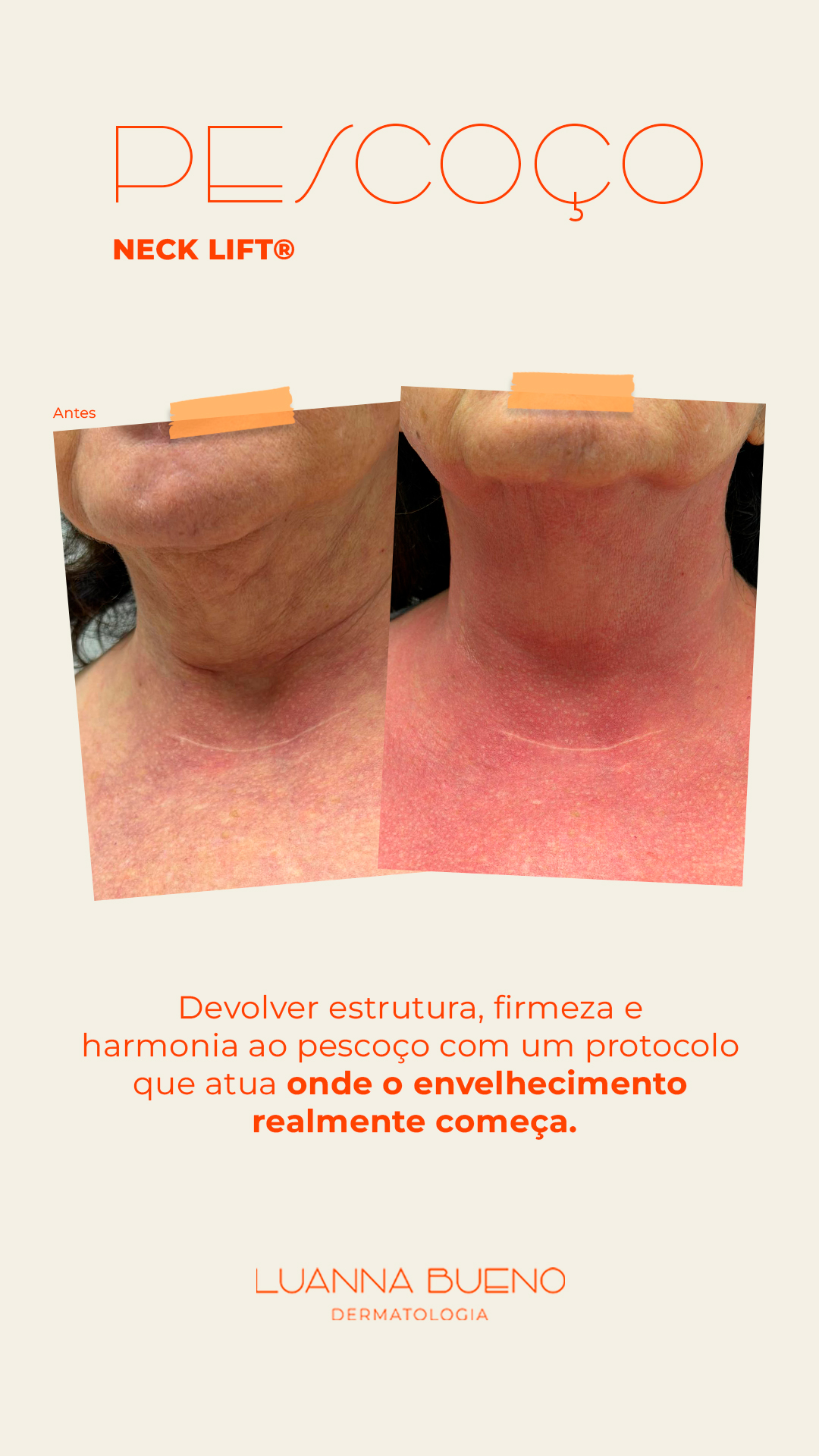 Dra. Luanna Bueno Facebook ad: Conheça o Neck Lift, um protocolo especial para…