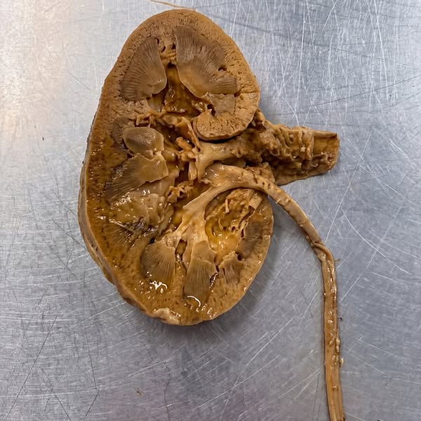 Dr. Tasha Reynolds - Nephrologist, MD Facebook ad: Your Kidneys Aren't Failing. They're Suffocating.