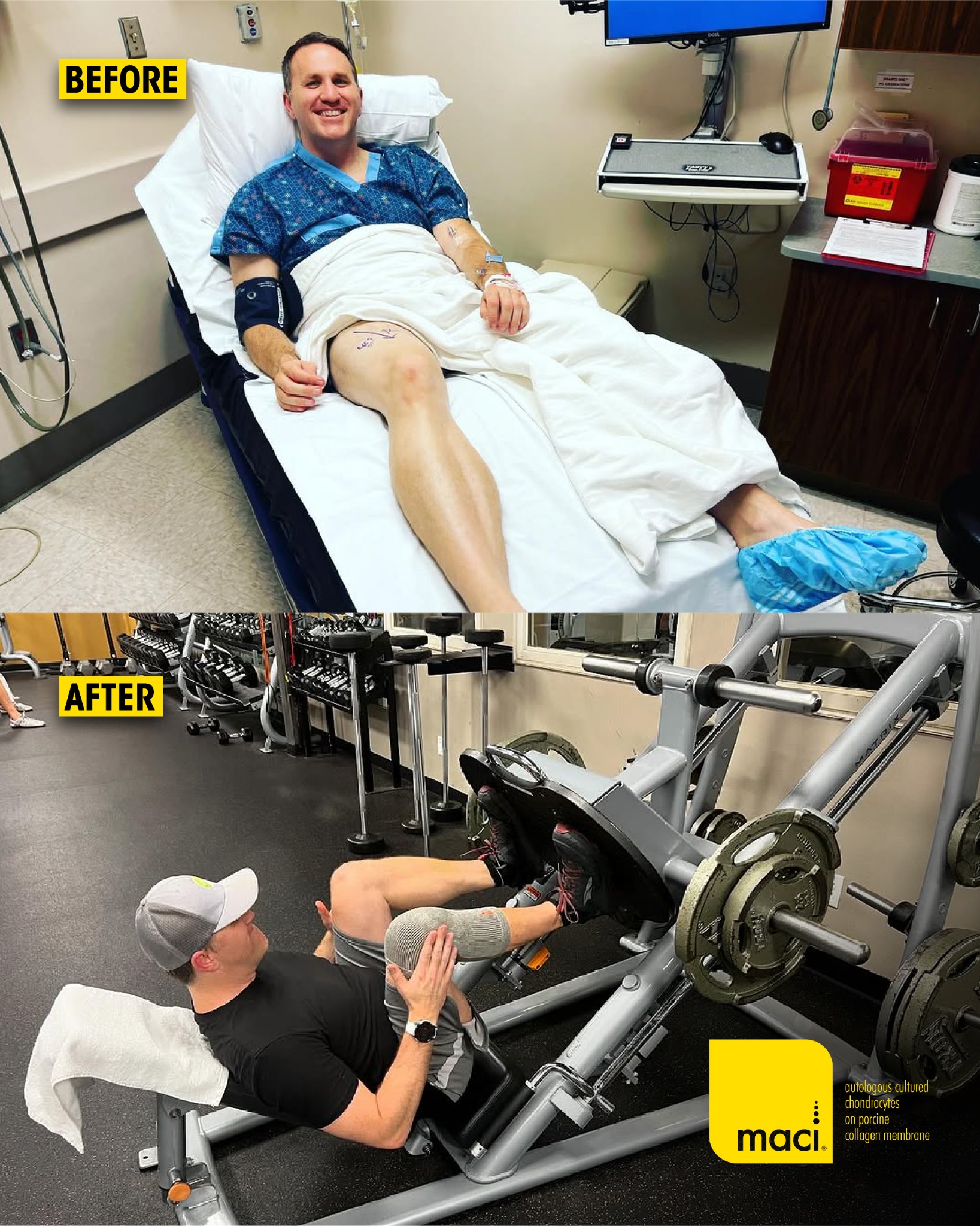 MACI Treatment Facebook ad: Hear Patient Success Stories