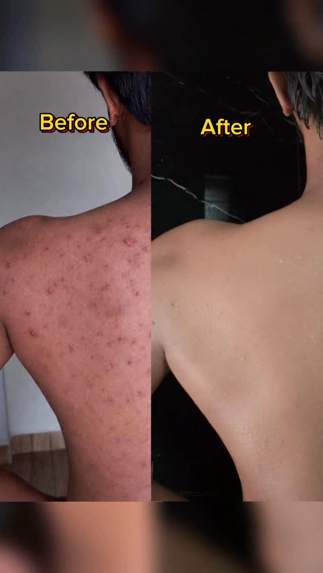 MCaffeine Facebook ad: Bumpy skin & back acne?