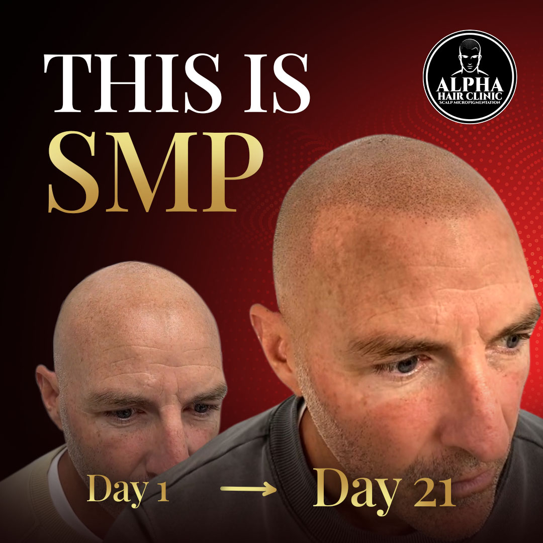 Alpha Hair Clinic Facebook ad: QLD Area, Stop Hair Loss Without Surgery