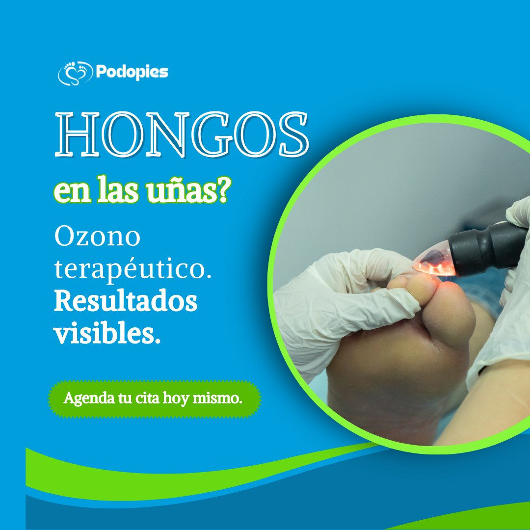 Podopies sede Tarapoto Facebook ad: ¡Decile adiós a los hongos de las uñas!
