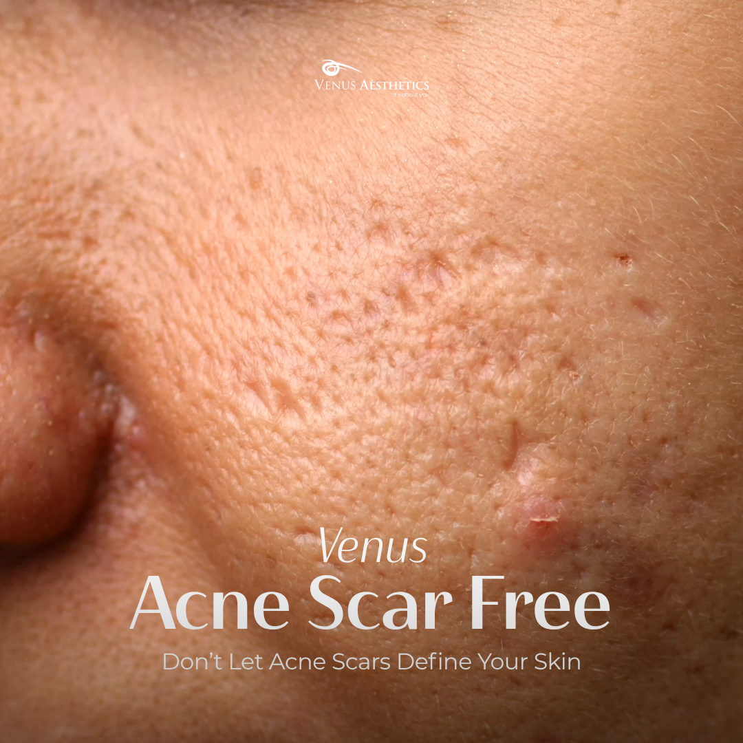 Venus Aesthetics Facebook ad