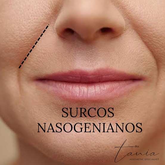 dra.taniasg Facebook ad: Los surcos nasogenianos o pliegues nasolabiales se forman…