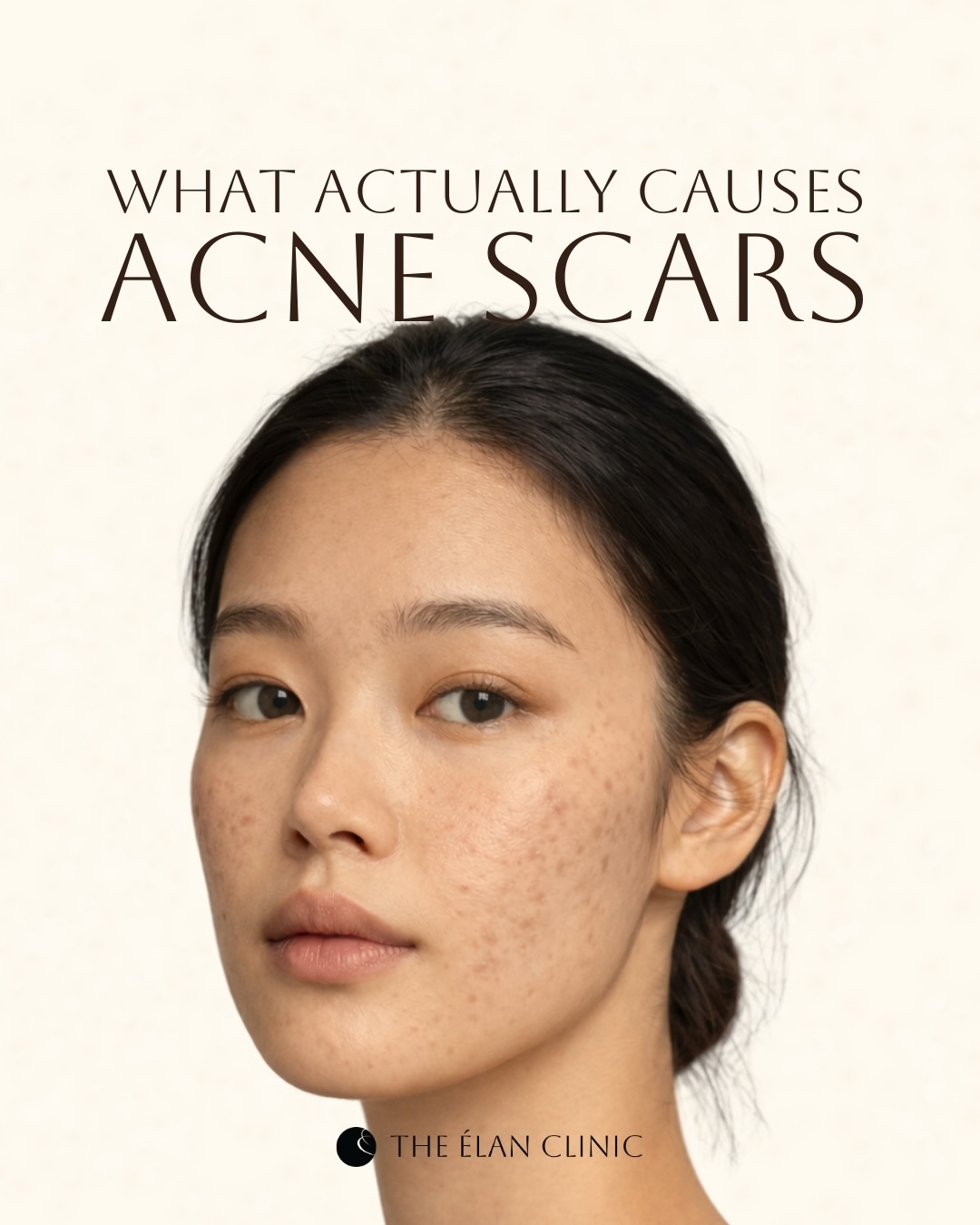 The Élan Clinic Facebook ad: Acne scars don’t form overnight, and they’re not…