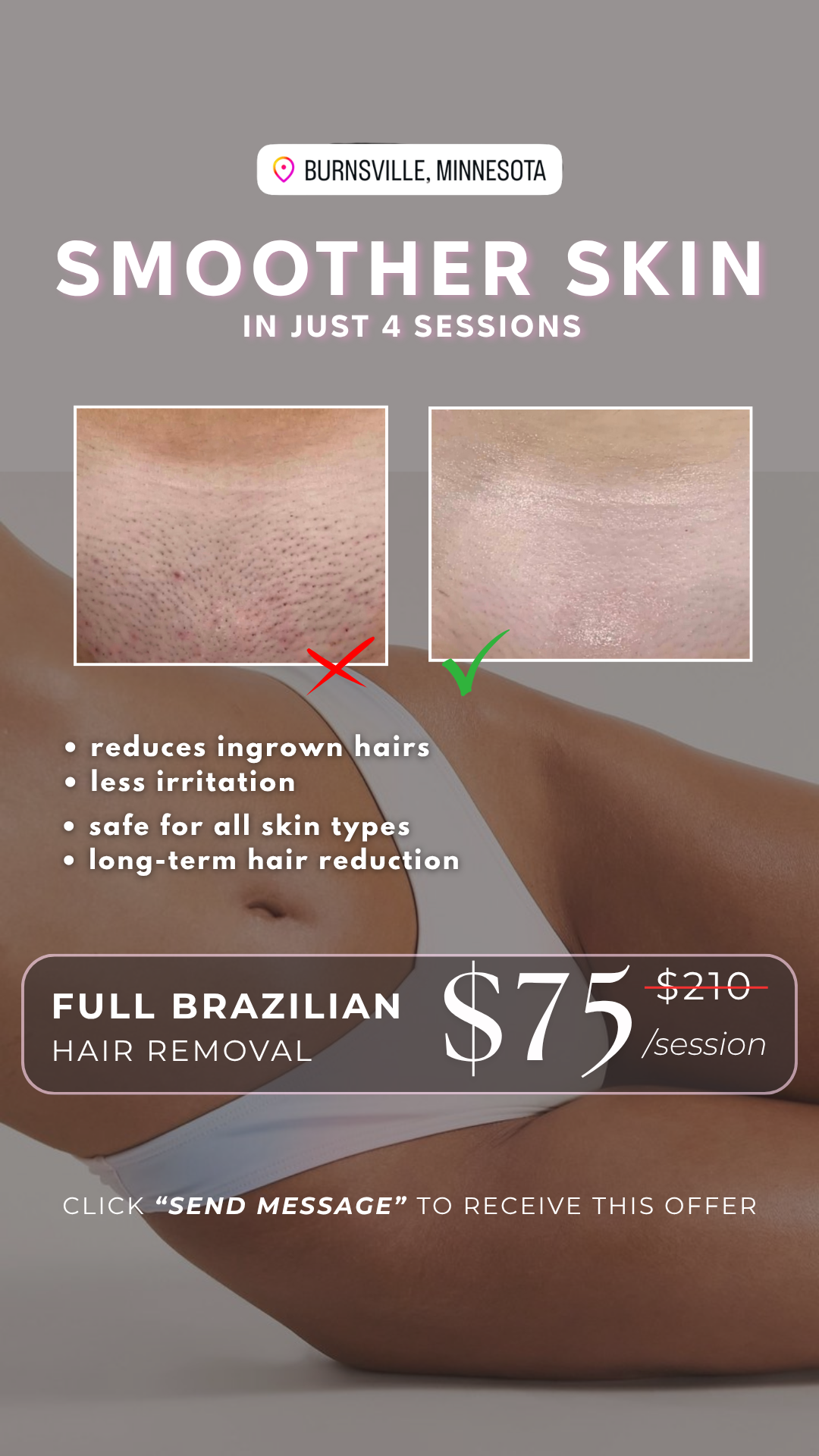 Grace & Wellness Facebook ad: Brazilian Laser for Just $75 (Reg.