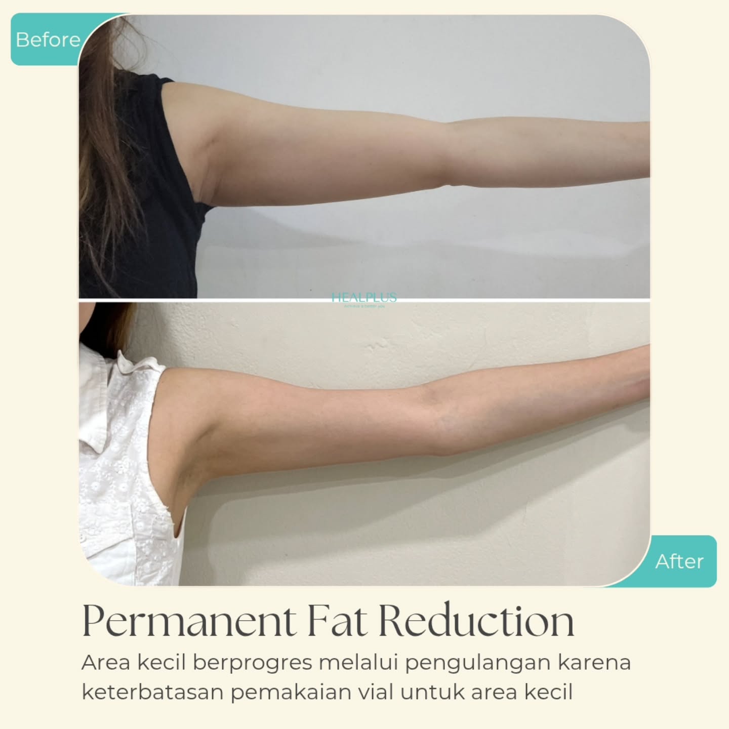 Healplus Homecare Facebook ad: Tidak ada mesolipo di Healplus