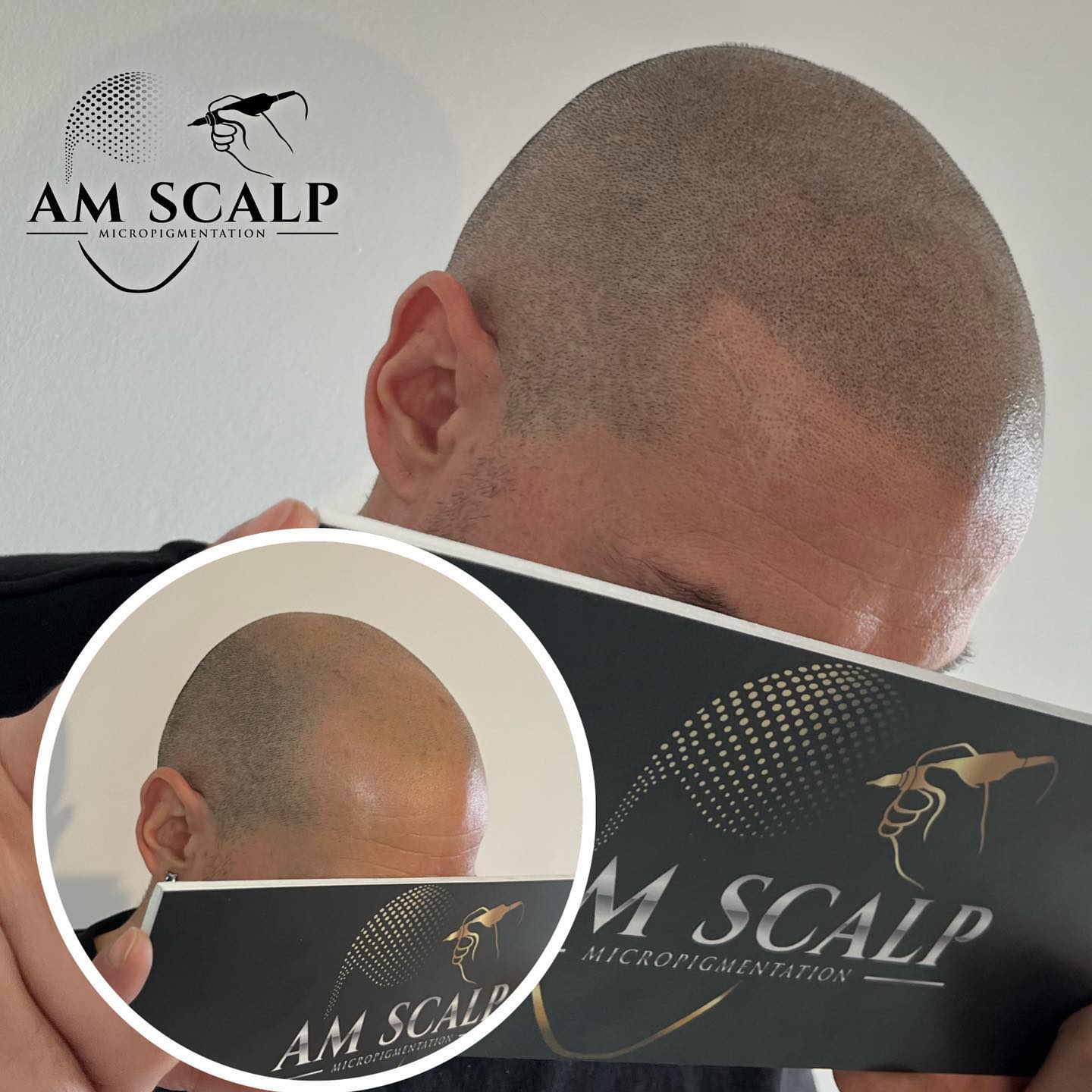 Am scalp Tricopigmentation Facebook ad: Qui de votre entourage se rendra compte que…