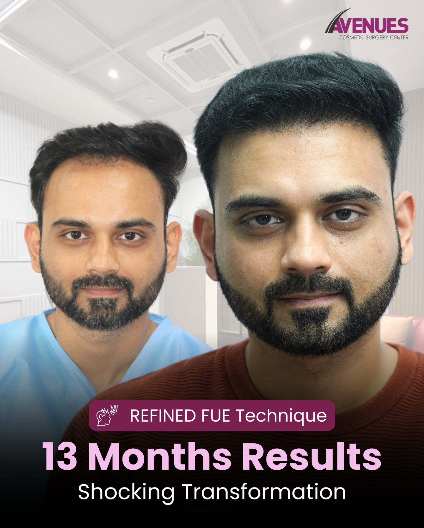 Avenues Cosmetic Surgery Center Facebook ad: Shocking 13 Months Hair Transplant Results at Avenues…