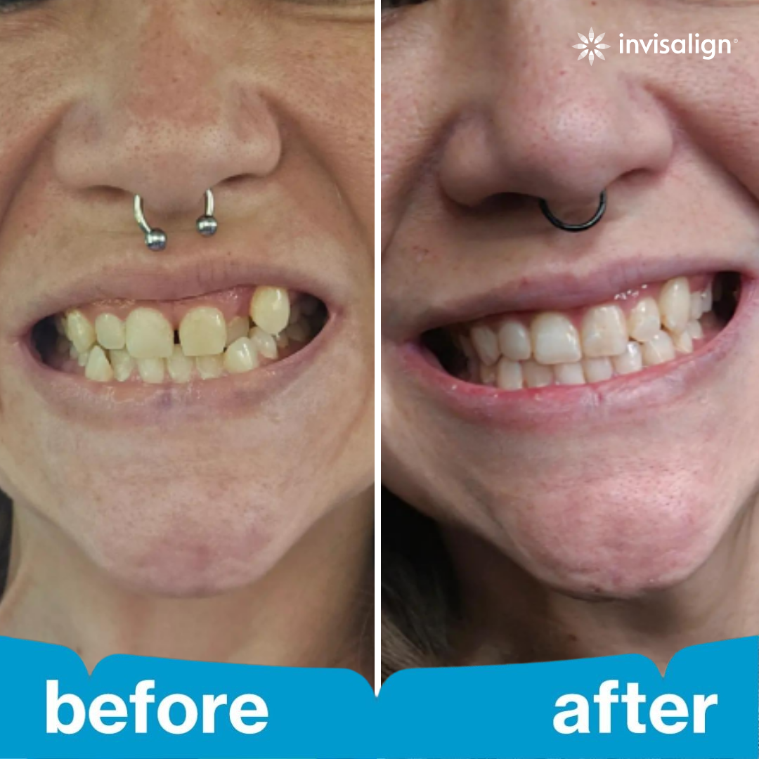 Invisalign Facebook ad