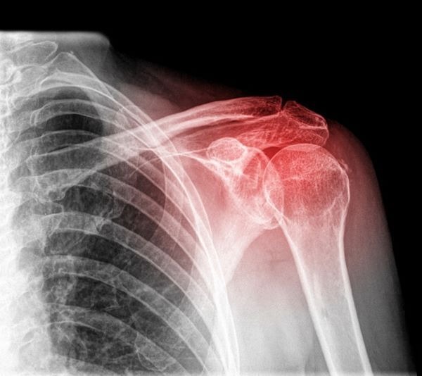 Complete Care Physiotherapy Centre - Etobicoke Facebook ad: 67$ Shoulder injury Deep Tissue Laser, Exam, & Consultation!