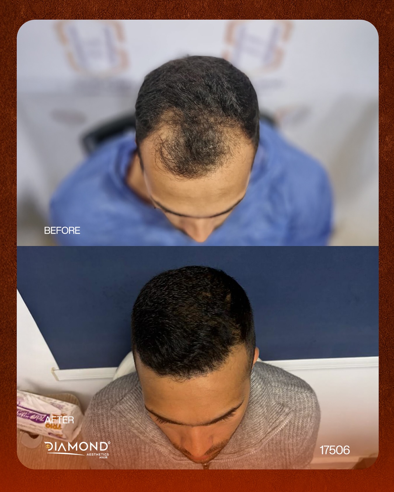 Diamond Hair Transplant Facebook ad: التغيير مش بس في الشكل… التغيير في الثقة!