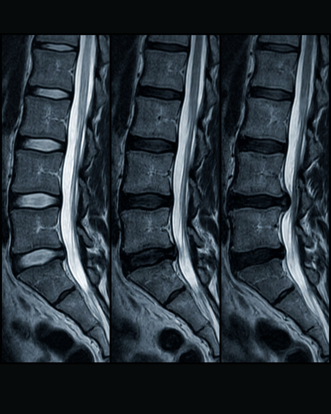 Emily Caldwell - Health After 50 Facebook ad: The most dangerous thing about sciatica isn't the pain.