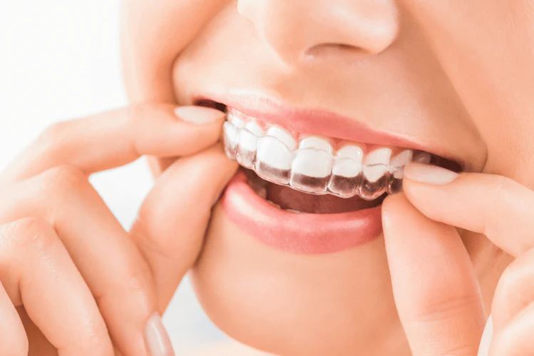 SeekerHub Search Deals Facebook ad: What’s Driving Interest in New Dental Aligner Companies