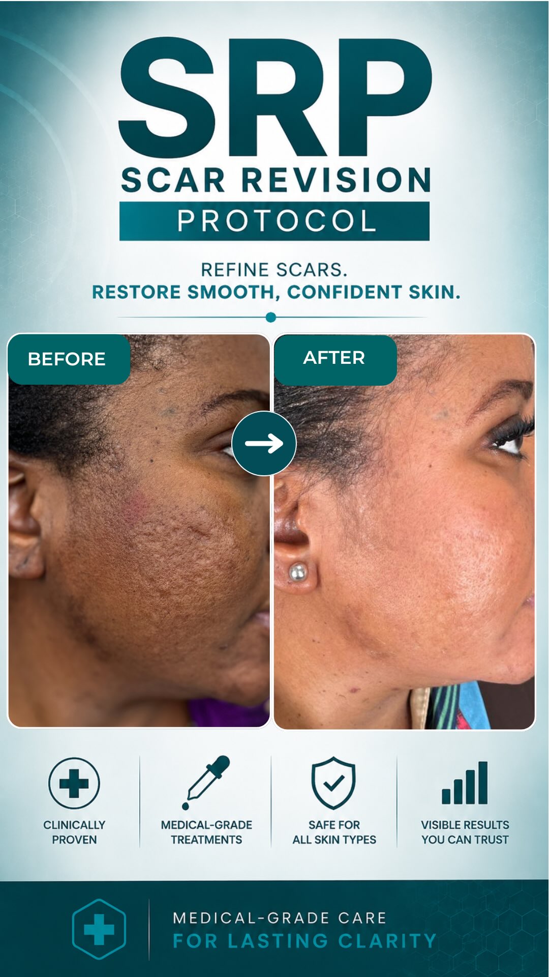 Bregha Beauty Brand Facebook ad: Acne scars usually stay because the skin structure…