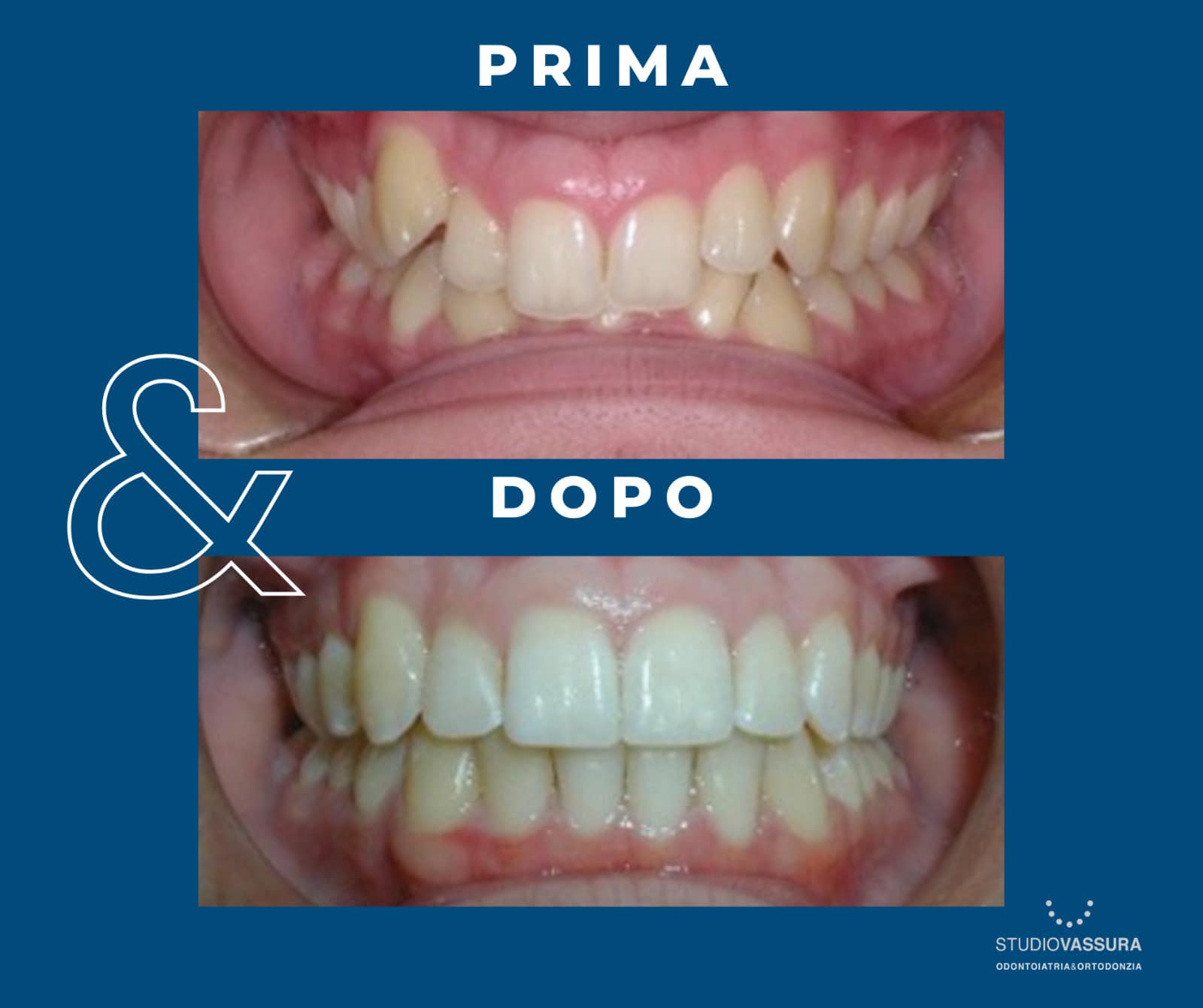 Studio Vassura - Dental Care Facebook ad: PRIMA E DOPO: trattamento ortodontico
