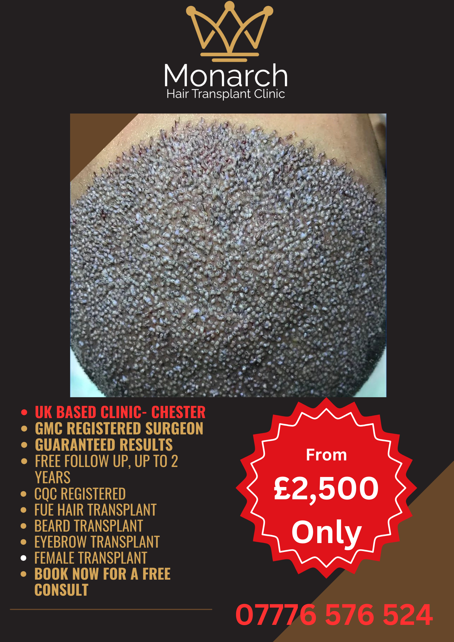Monarch Hair Transplant Clinic Facebook ad: Hair Transplant in UK