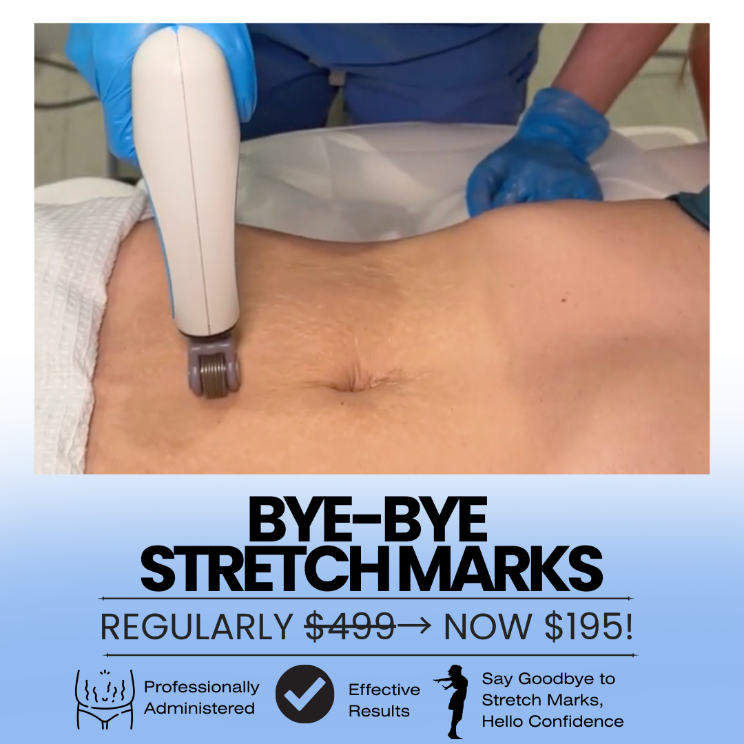 The GLO Skin Tight Laser Club NOMAD Facebook ad: Fade Stretch Marks and Renew Your Skin with our Bye-Bye…