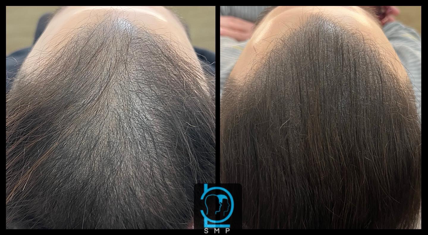 LC Scalp Micropigmentation Cyprus Facebook ad: From visible thinning… to instant fullness.