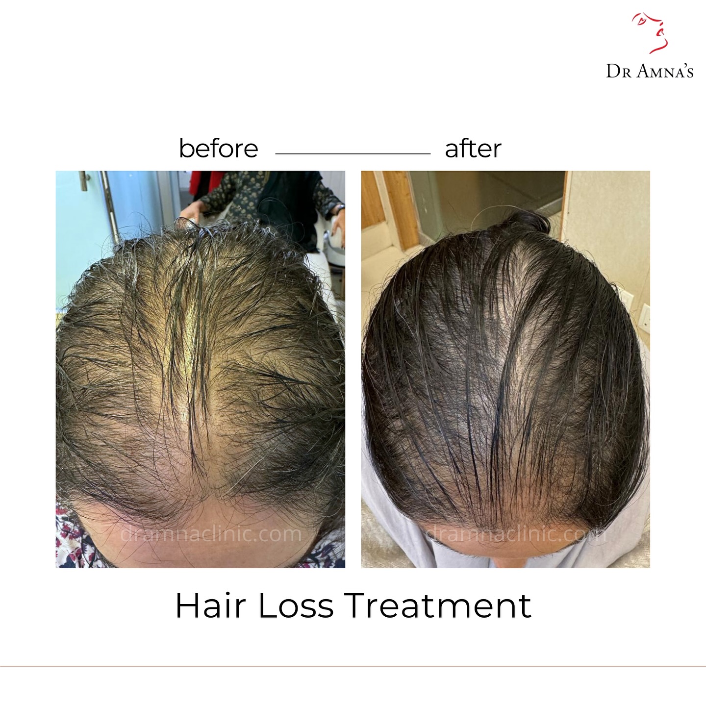 Dr. Amna's Skin Clinics Facebook ad: Non Surgical Hair Restoration with Exosomes Treatment!