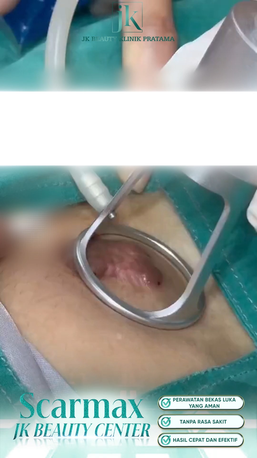 Scarmax - JK Beauty Klinik Pratama Facebook ad: TEKNOLOGI PERAWATAN BEKAS LUKA KELLOID SECARA TUNTAS DI…